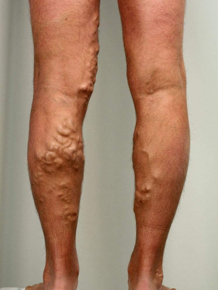 Actovegin treatment of varicose veins
