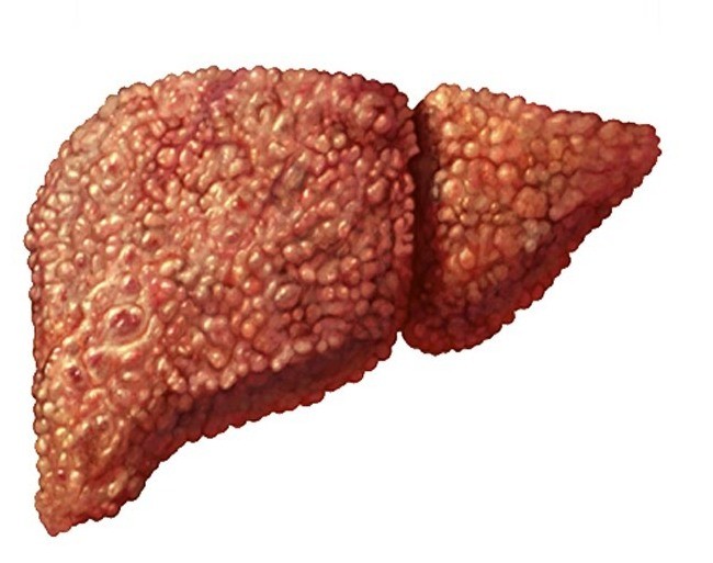 Cirrhosis of the liver Heptral, Layennec