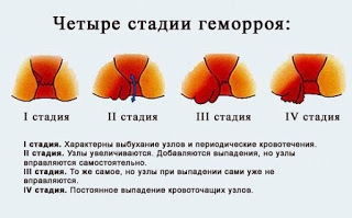 Treatment of hemorrhoids