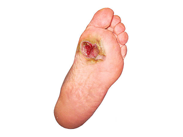 Diabetic foot. Actovegin buy