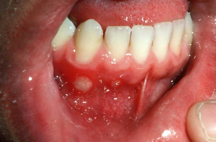 Stomatitis