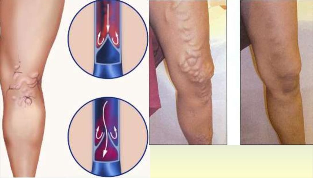 Actovegin. Chronic venous insufficiency.