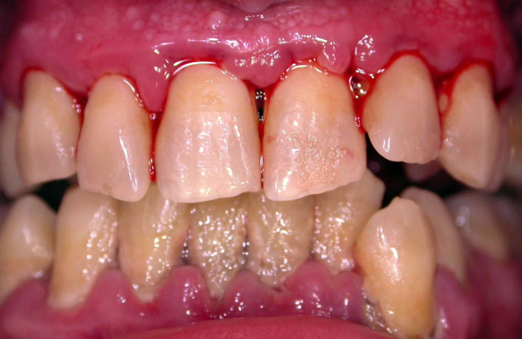 Solcoseryl. Periodontitis.